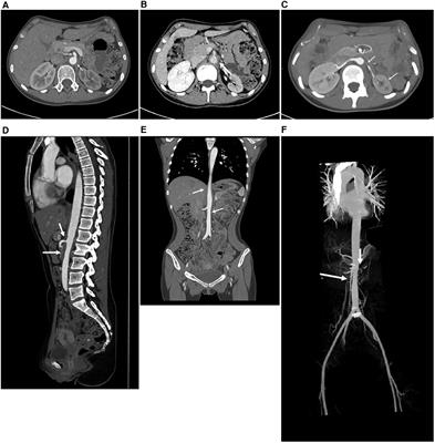 Adolescent Takayasu's arteritis with hypertensive intracerebral hemorrhage: a case report and literature review